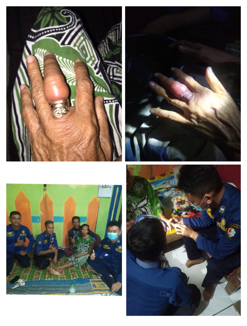 Jari  Bengkak Karena Tertekan Cincin Sebanyak 3 buah